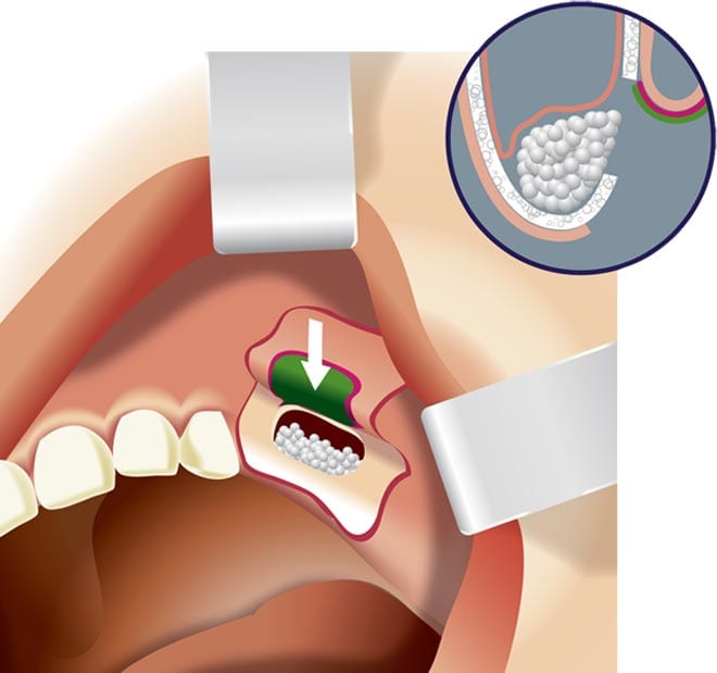 sinus lifting and bone grafting materials placed under Schneiderian membrane