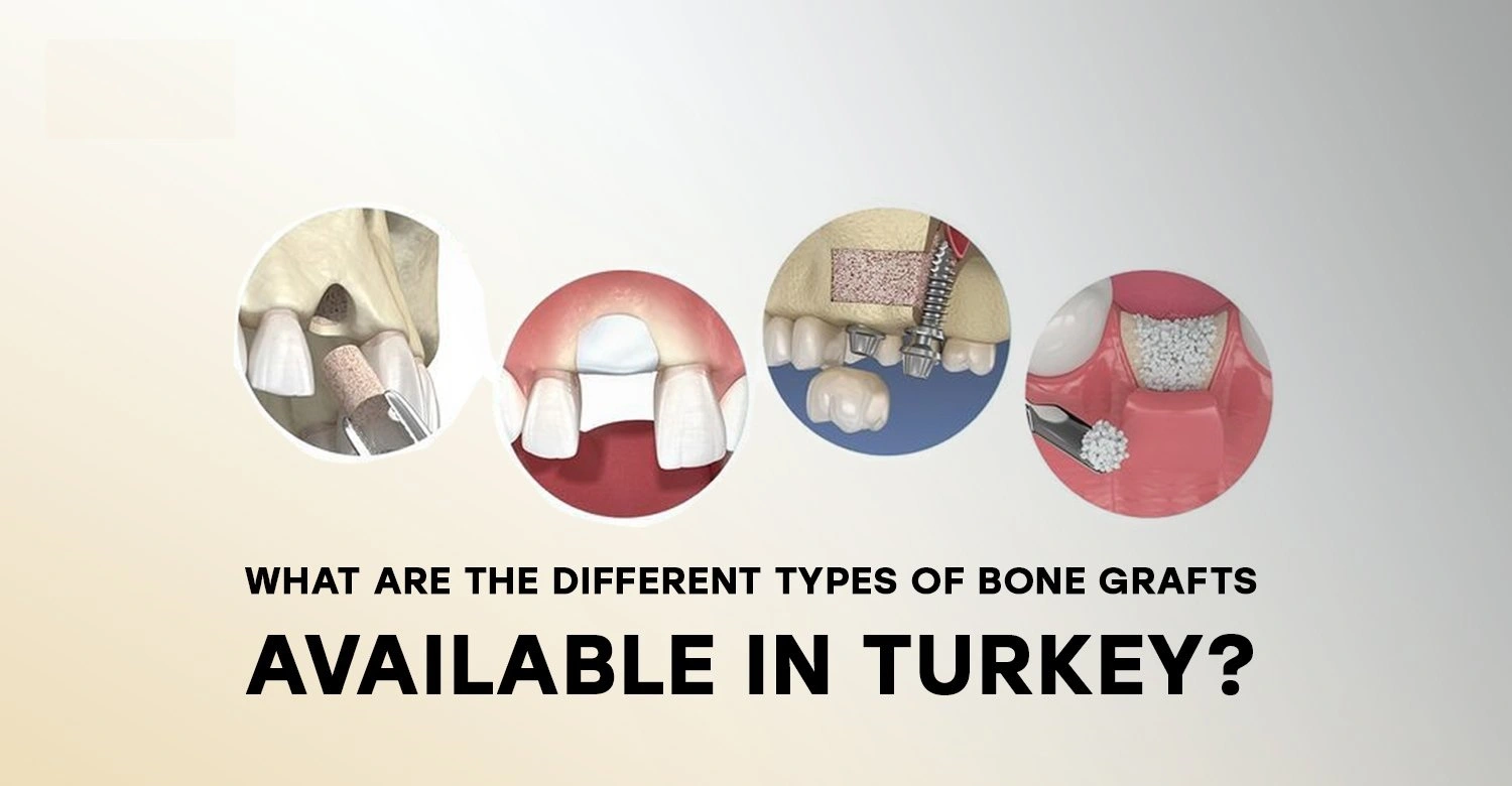 bone grafting types compared