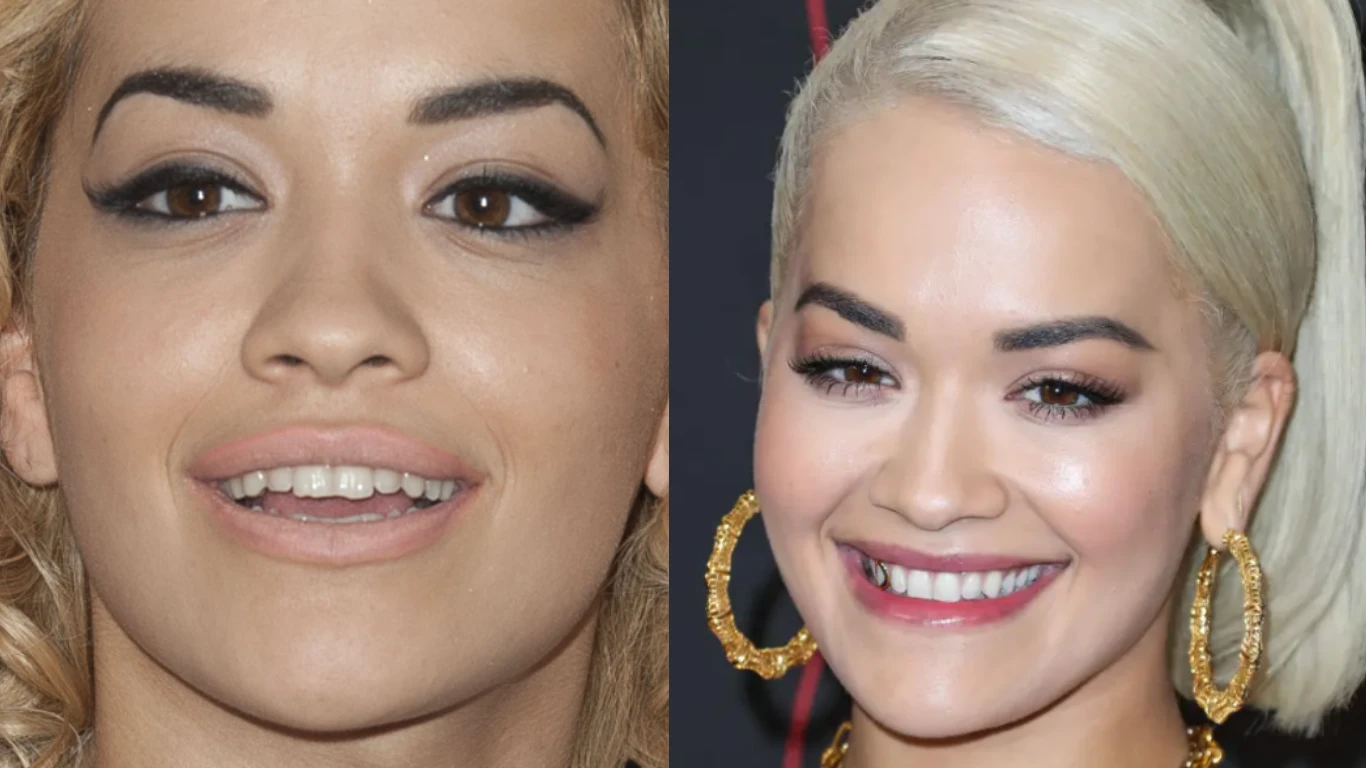 Rita Ora Teeth Transformation