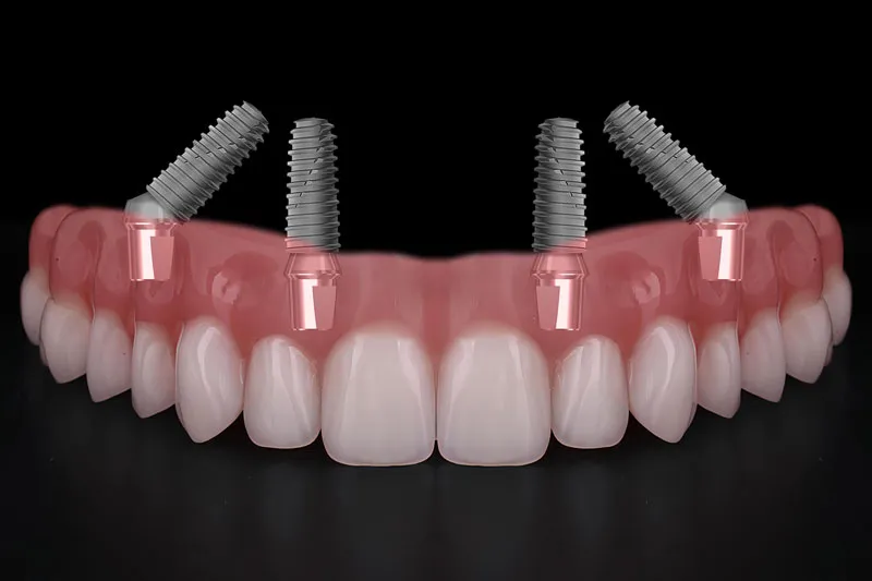temporary teeth after dental implants during the healing period